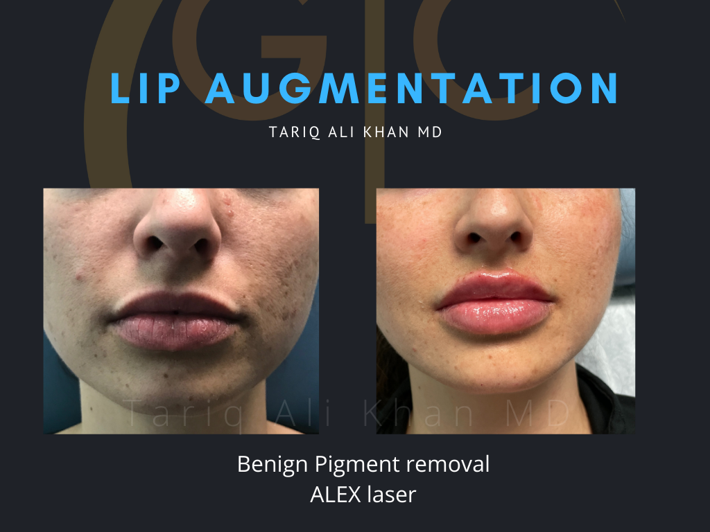 Gentle Care Laser Tustin & Long Beach Before and After picture - Lip Augmentation